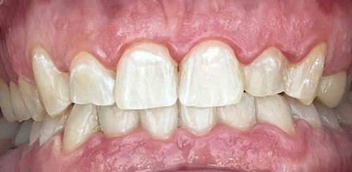 Patient smile after treatment