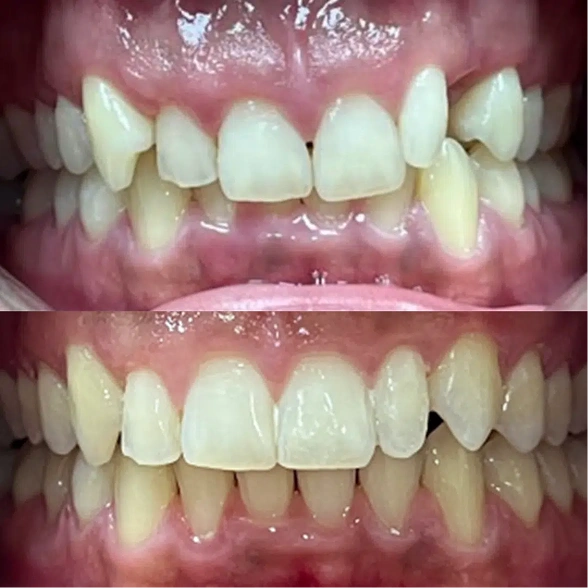 Real patient overbite correction, before and after