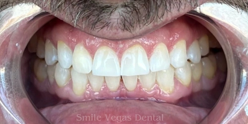 Patient teeth after Invisalign treatment