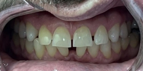Patient teeth before Invisalign treatment