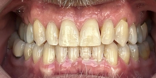 Patient teeth before whitening treatment