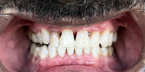 Patient teeth after Zoom whitening