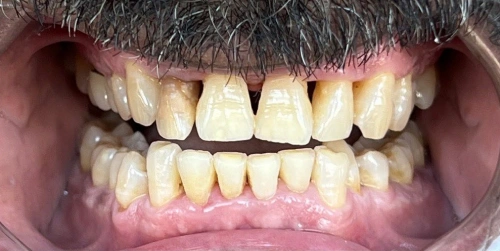 Patient teeth before Zoom whitening